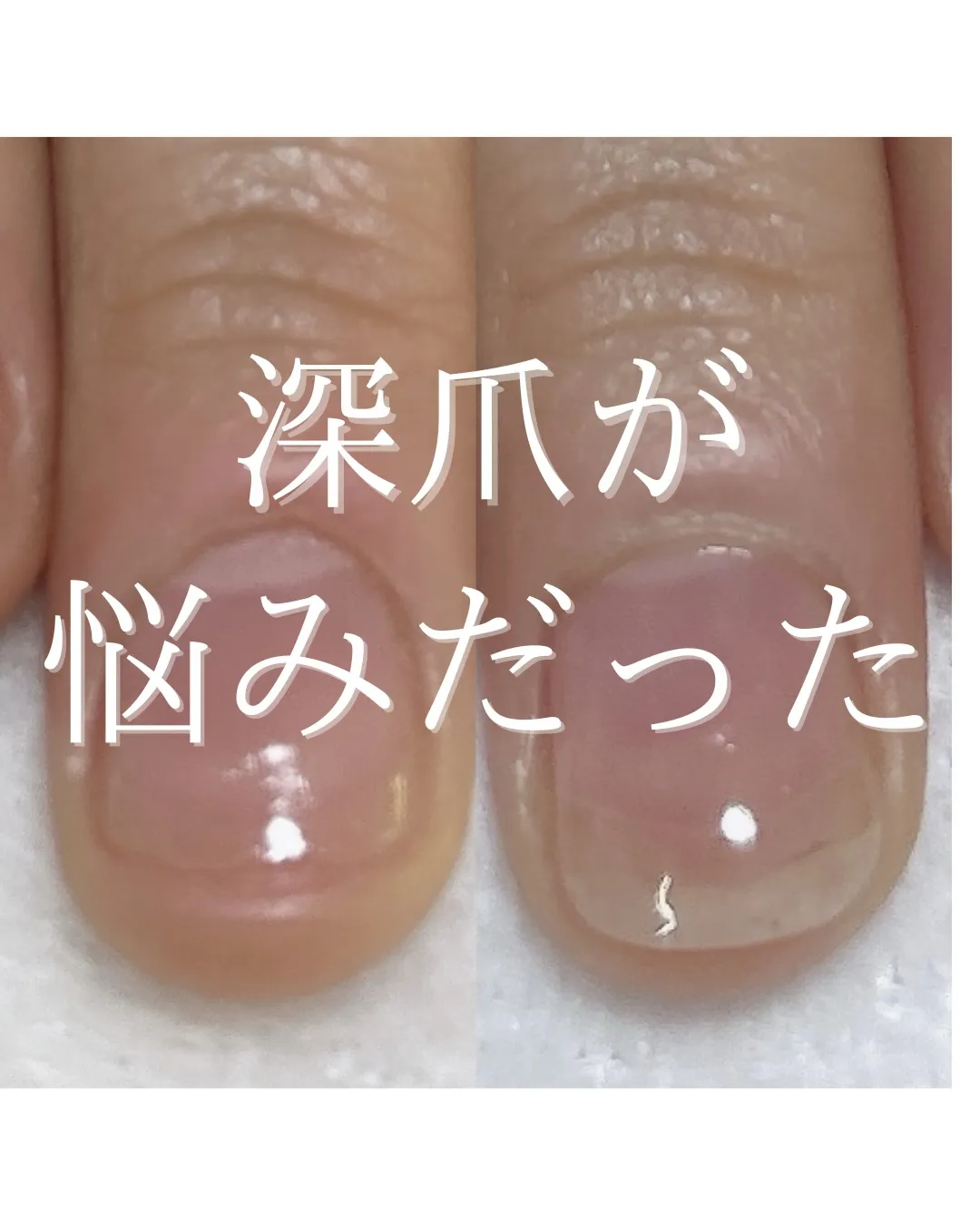 【深爪がずっと悩みだった】